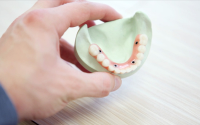 Top Tooth Replacement Options